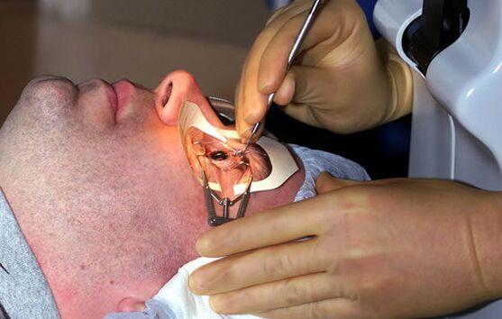 Skleroplastyka w leczeniu krótkowzroczności w celu stabilizacji wzroku