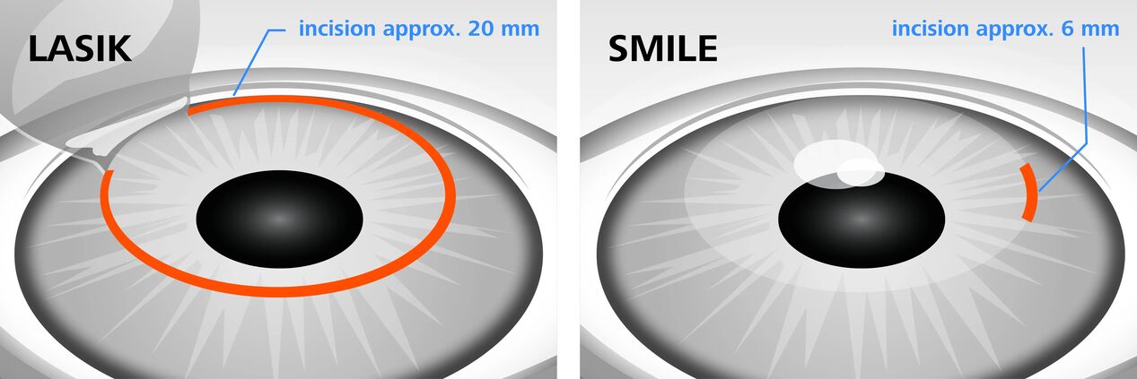 Porównanie metod laserowej korekcji wzroku LASIK i SMILE